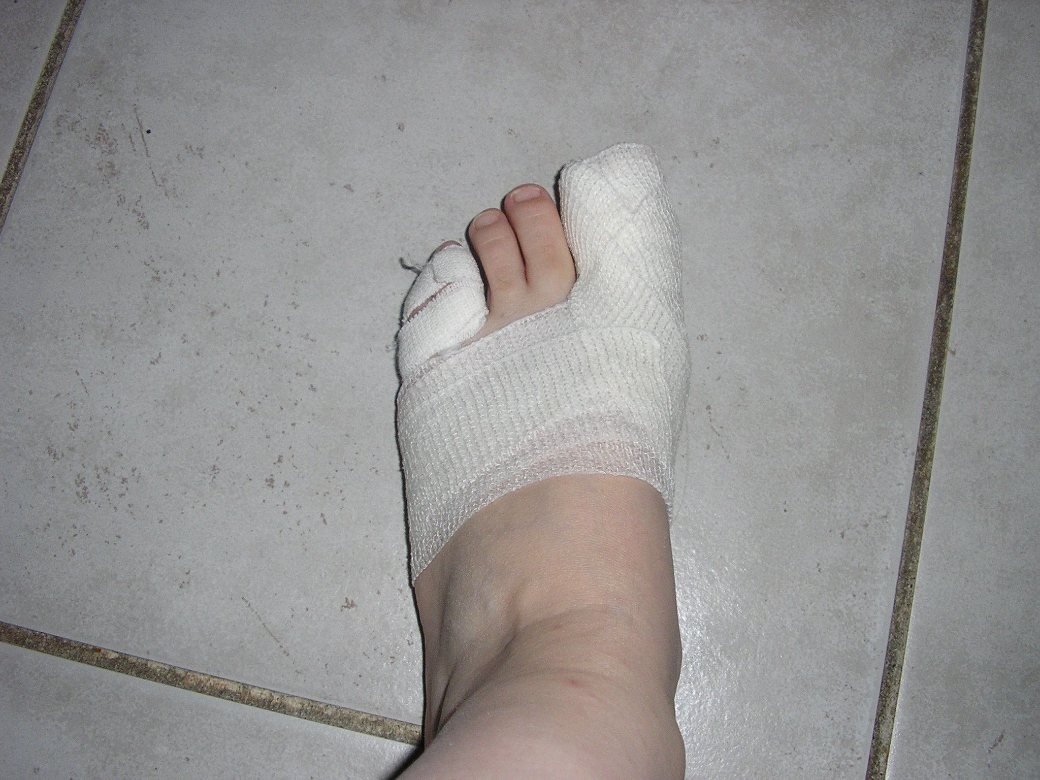 Marie et sa fracture de l'orteil Centerblog